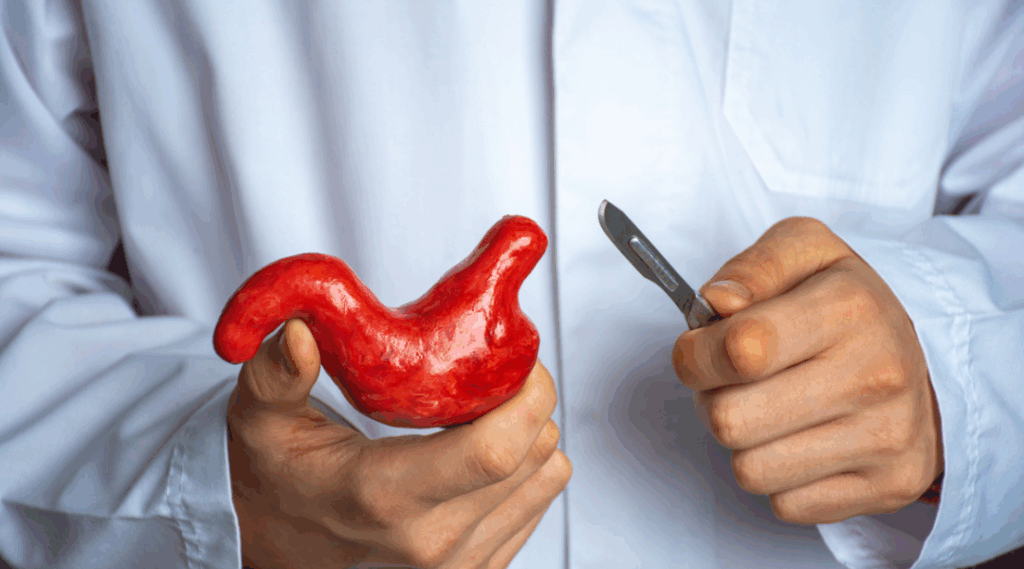 Sleeve γαστροπλαστική